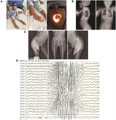 Novel NtA and LG1 Mutations in Agrin in a Single Patient Causes Congenital Myasthenic Syndrome